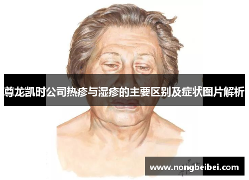 尊龙凯时公司热疹与湿疹的主要区别及症状图片解析